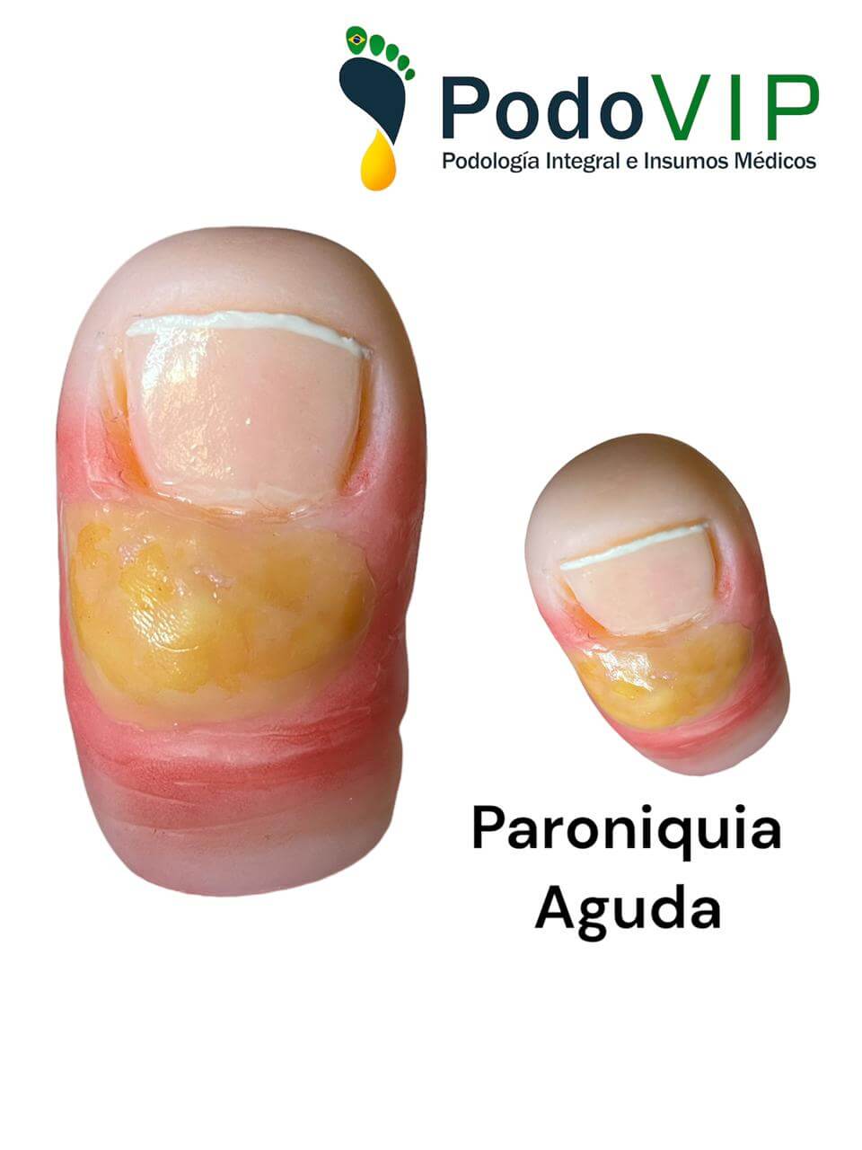 Paroniquia Aguda