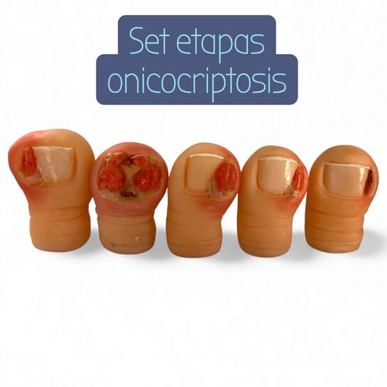 Set etapas de onicocrptosis