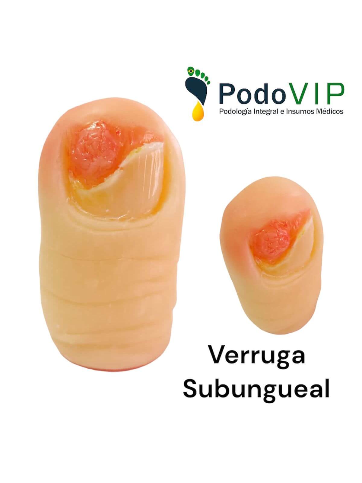 Verruga Subungueal